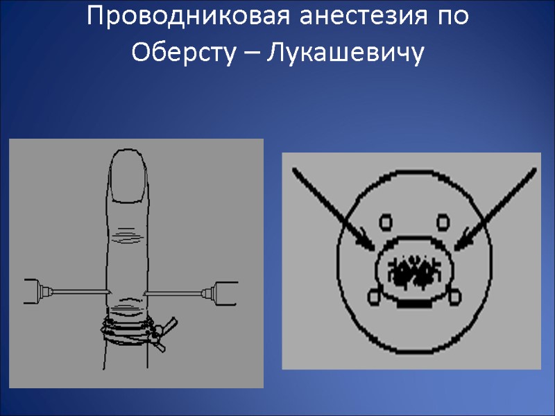 Проводниковая анестезия по Оберсту – Лукашевичу